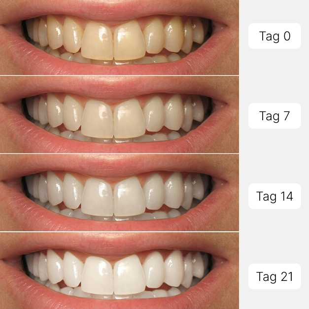 Teeth Whitening Strips - 3 Stk.